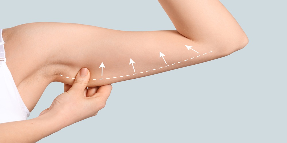 Arm Lift Surgery Belfast Ireland